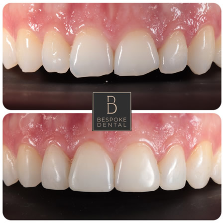 Smile Gallery Composite Edge Bonding in Reading