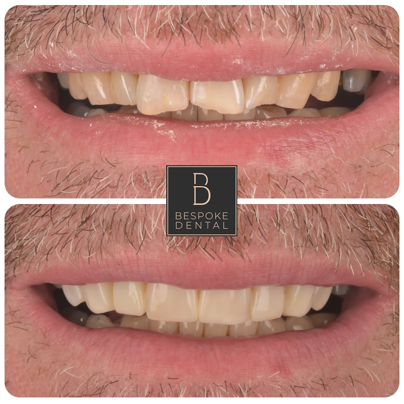 Smile Gallery Whitening and Composite veneers Reading