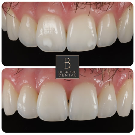 Smile Gallery Composite Bonding