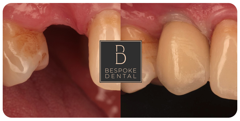 Dental implants at Bespoke Dental Reading