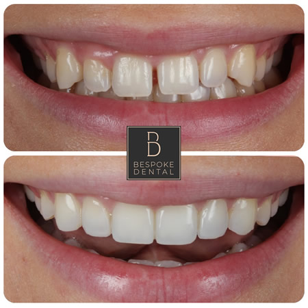 Invisalign, Whitening and Composite Bonding