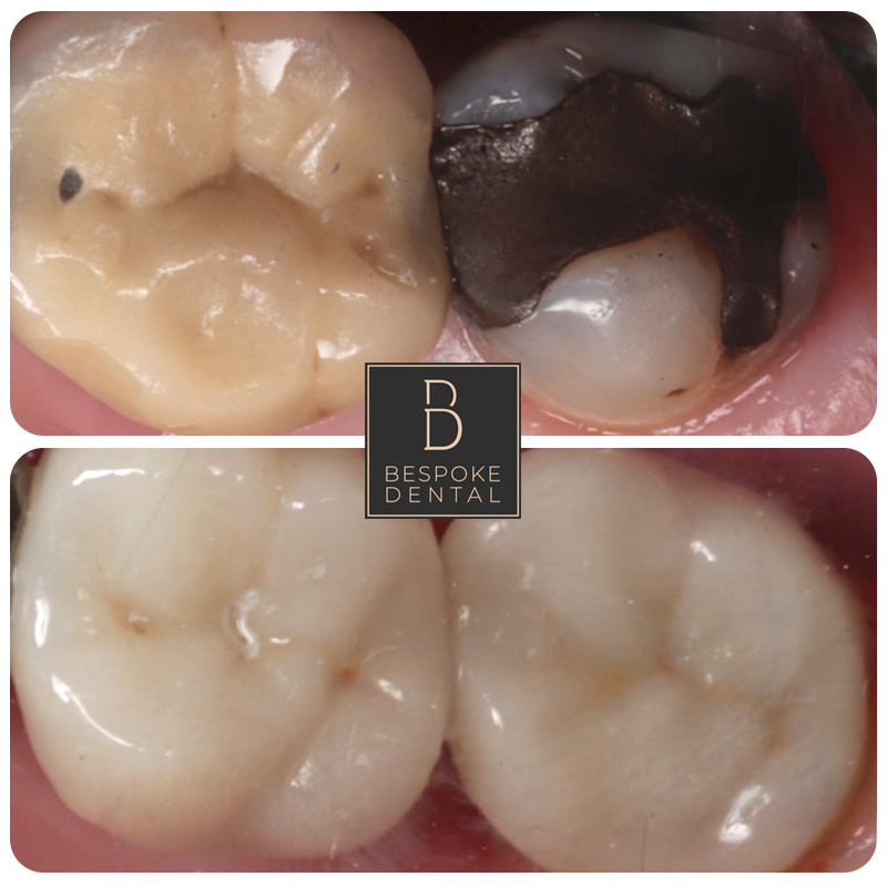 Ceramic restorations in Reading