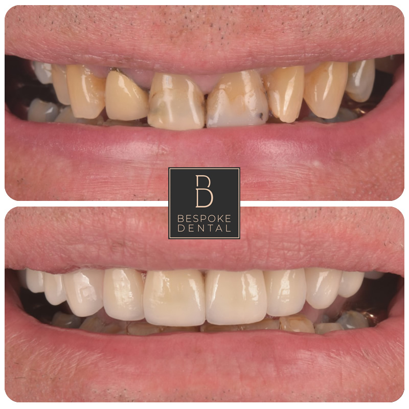 Smile Gallery Barry - Porcelain Veneers and Crowns