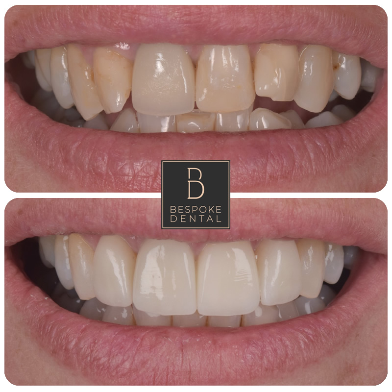 Invisalign, Whitening, Porcelain Veneers