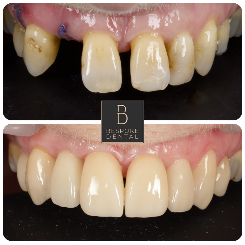 Smile Gallery Porcelain Veneers and an Implant
