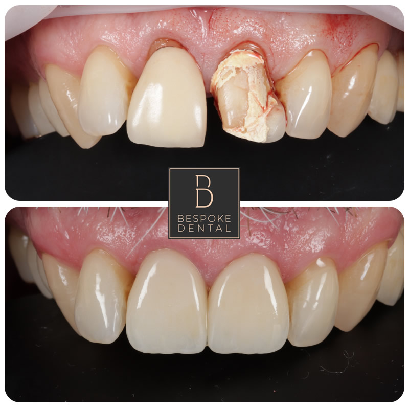 Porcelain Veneers