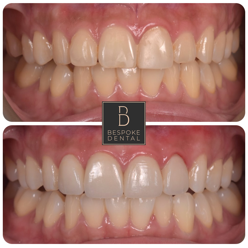 Smile Gallery Victoria - Whitening and Porcelain Veneers