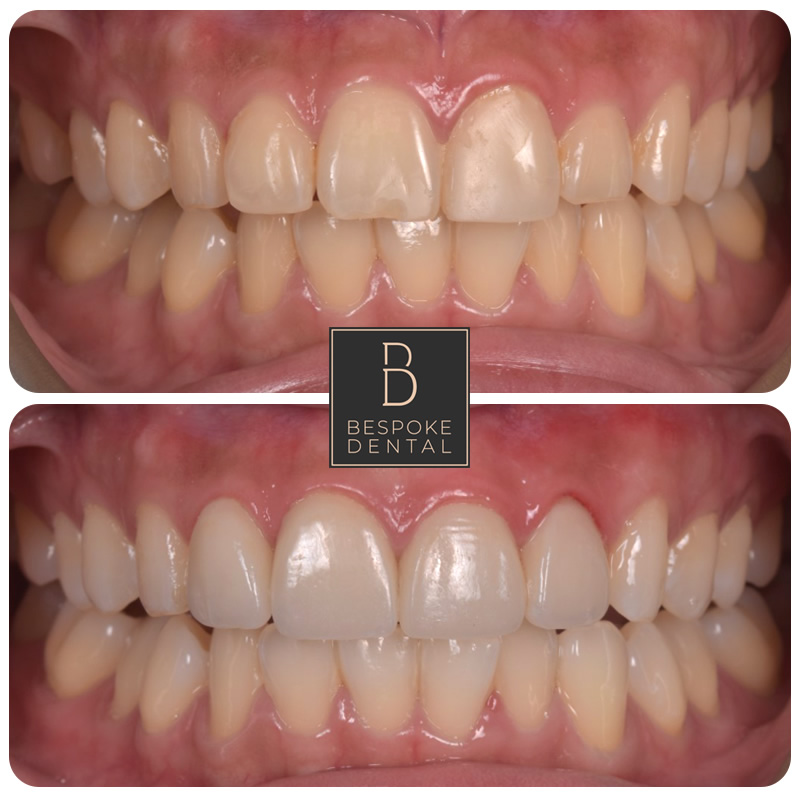 Whitening and Porcelain Veneers